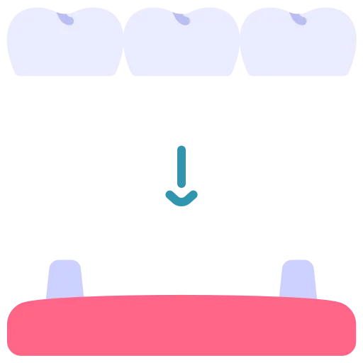 Teeth Grinding (Bruxism)